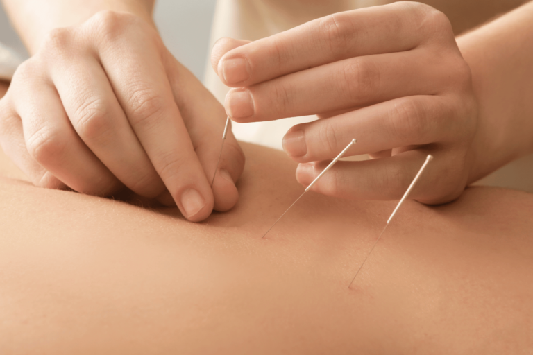 L’acupuncture